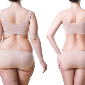 Non-Surgical Cellulite Solutions
