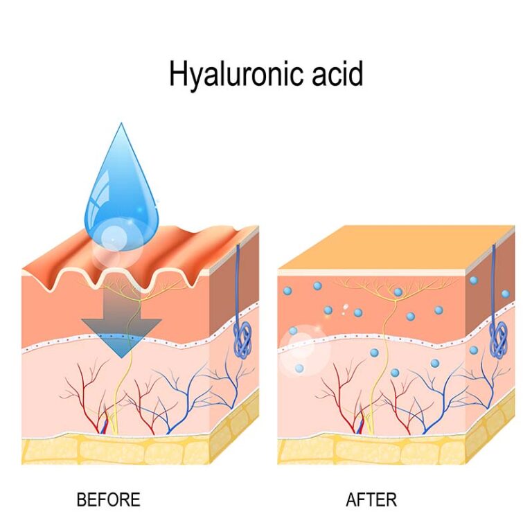 5 Reasons Hyalurionic Acid Is You Skin’s Best Friend