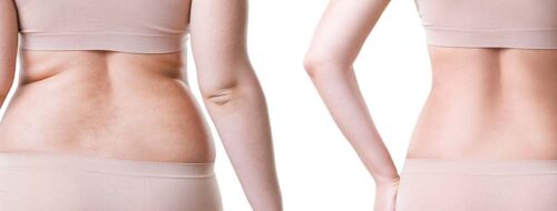 Non-Surgical Cellulite Solutions